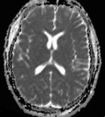 Apparent Diffusion coefficient (ADC) map