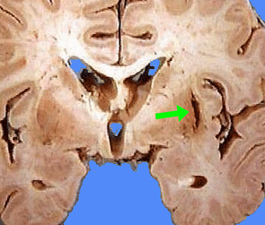 slit hematoma