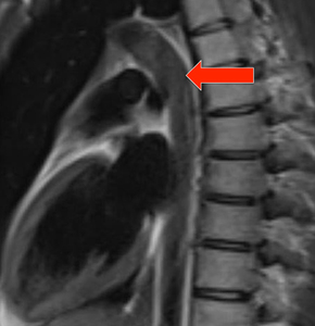 Double inversion recovery artifact