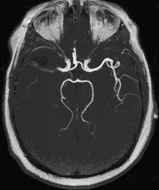 TOF MRA artifacts: susceptibility