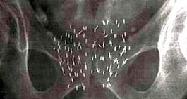  brachytherapy seeds xray